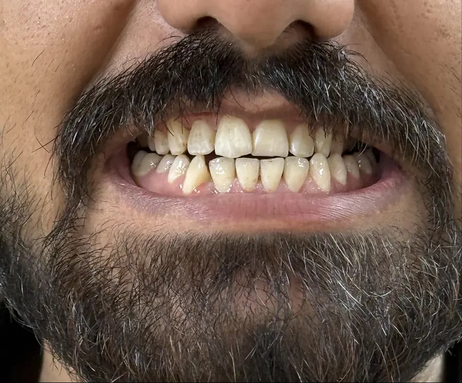 What Causes Yellow Teeth (and How to Prevent It) After