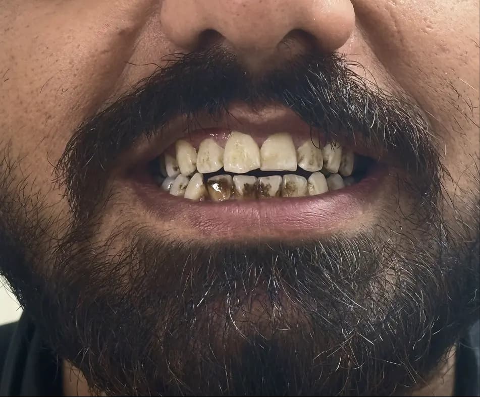 What Causes Yellow Teeth (and How to Prevent It) Before